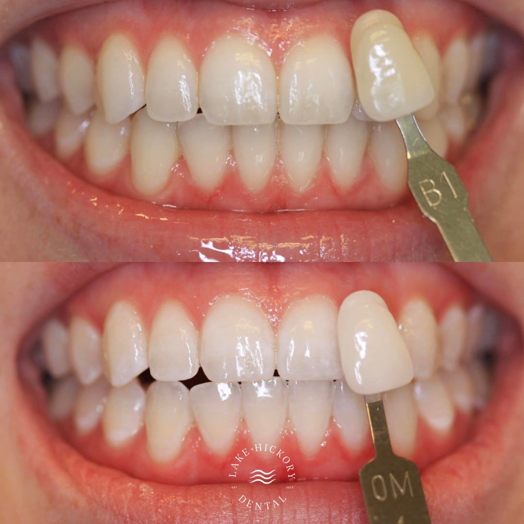 Dr. Robert Steljes. Lake Hickory Dental. General Dentist, General & Family, Cosmetic Dentistry, Restorative Dentistry, SureSmile Clear Aligners, Dental Implants, CEREC Same-Day Crowns, Extractions, Root Canal Therapy, Emergency Dentistry, Teeth Whitening, Veneers. Dentist in Hickory, NC 28601