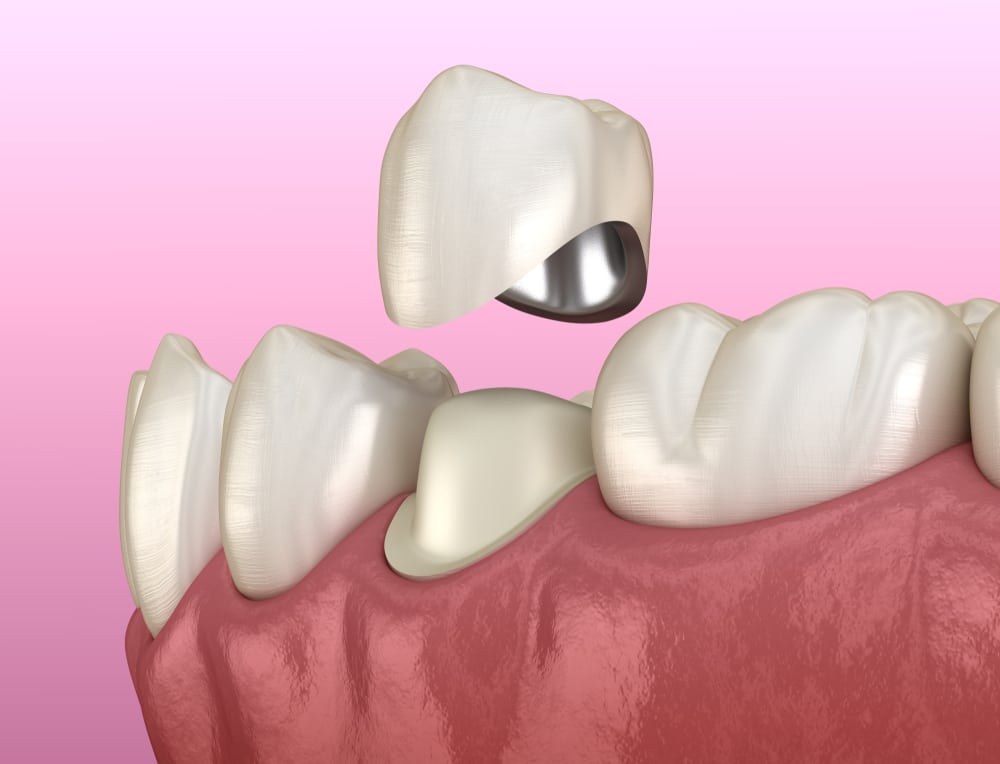cerec dental crowns hickory