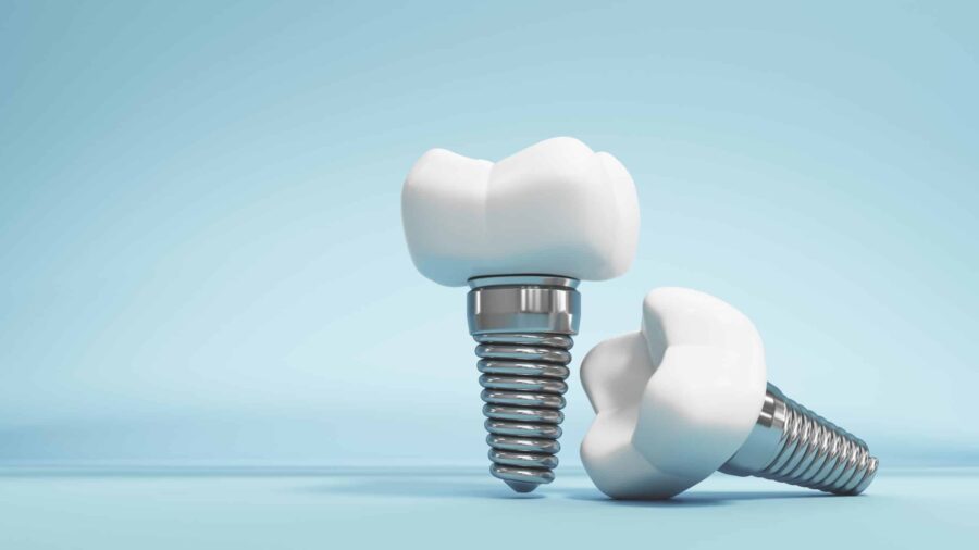 dental implants hickory