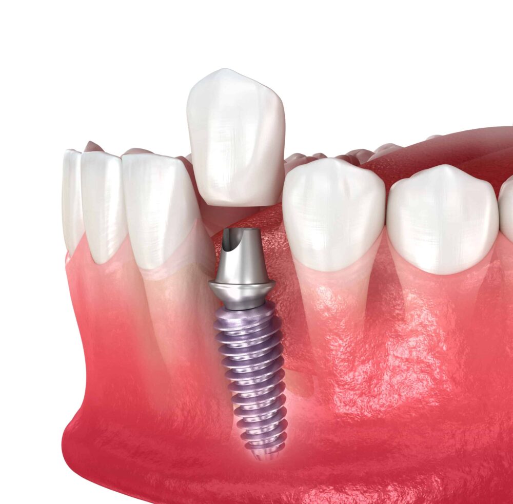 symptoms of loose dental implant crown